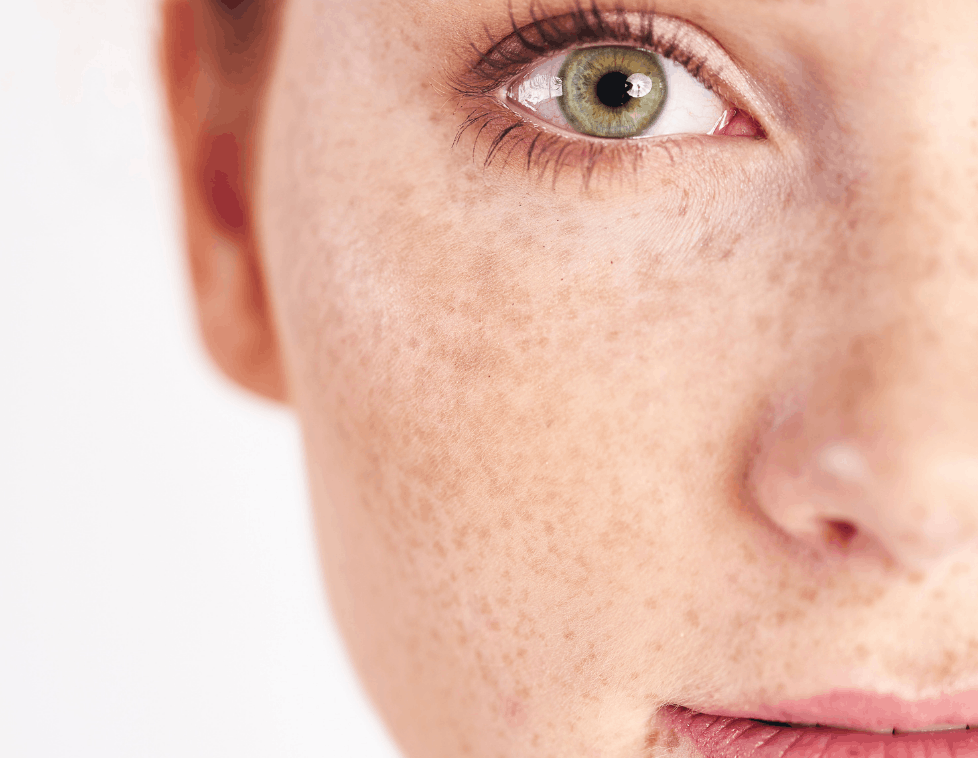 Close-up of a green eye with freckles on fair skin.