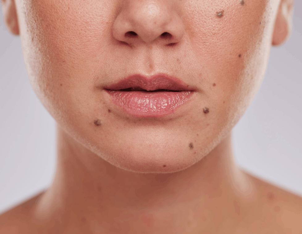 Close-up of a woman's lower face with multiple moles on her skin.