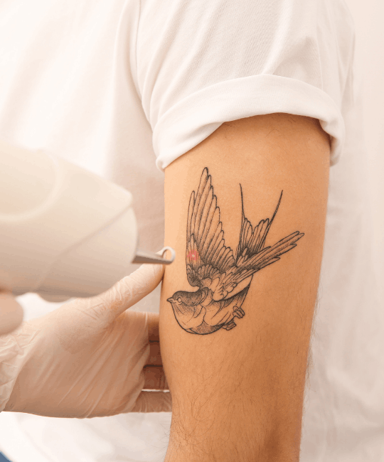 Tattoo removal procedure on a bird tattoo on the arm.