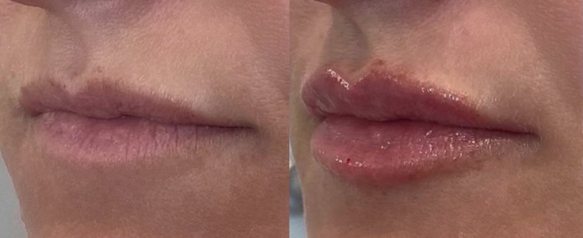 Close-up of lips before and after cosmetic enhancement.