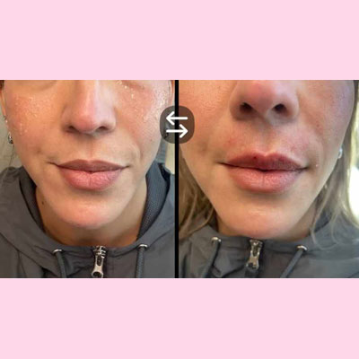 before/after lip filler 1