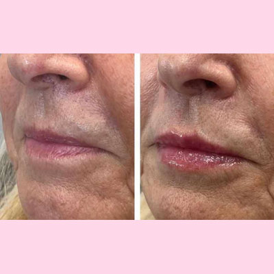 before/after lip filler 3