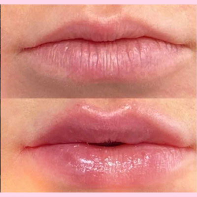 before/after lip filler 4