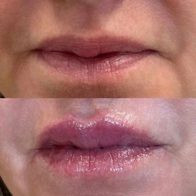 before/after lip filler 5