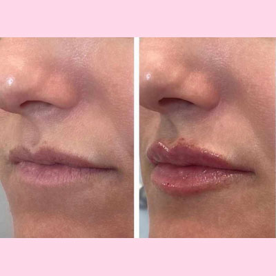 before/after lip filler